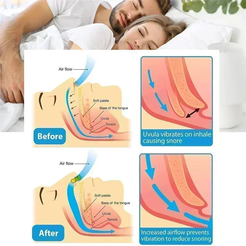 Anti-Snoring Corrector Snore Prevention Gadget Women's Anti-Snore Device Snore Elimination Nose Clip Men's Sleep Night